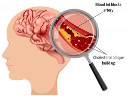 Dokter Bagikan Ciri-Ciri Gejala Stroke yang Harus Diwaspadai