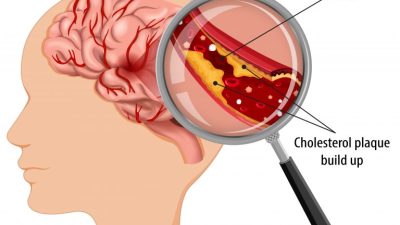 Human anatomy with atherosclerosis stroke illustration