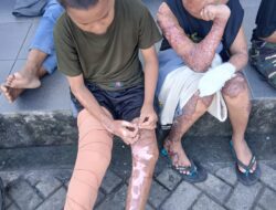 Dua Santri korban Yang dibakar hidup-hidup di Ponpes Lombok Tengah di Duga Tidak lagi dicover BPJS setelah Lapor Polisi